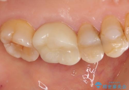 目立つ銀歯を白くしたい。オールセラミッククラウンによる補綴治療の治療後
