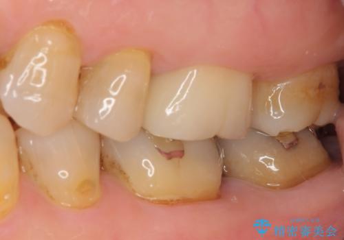 目立つ銀歯を白くしたい。オールセラミッククラウンによる補綴治療の治療後