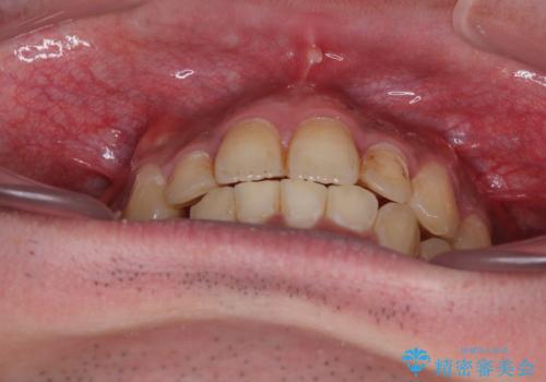 【モニター】飛び出した上の前歯 非抜歯矯正で整った口元にの治療後