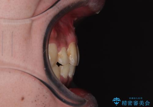 【モニター】飛び出した上の前歯 非抜歯矯正で整った口元にの治療後