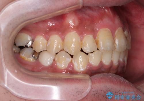 【モニター】飛び出した上の前歯 非抜歯矯正で整った口元にの治療後