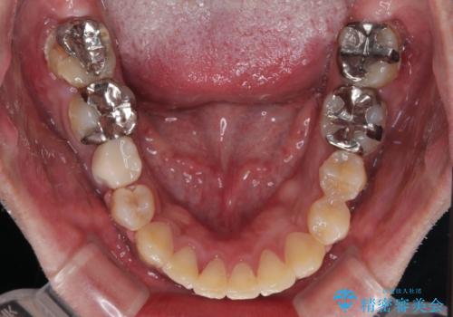 【モニター】飛び出した上の前歯 非抜歯矯正で整った口元にの治療後