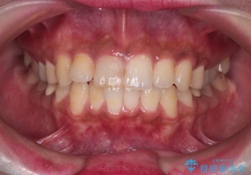 前歯の突出感を改善|上下4本の抜歯と審美ワイヤー矯正でバランスの取れた口元への治療前