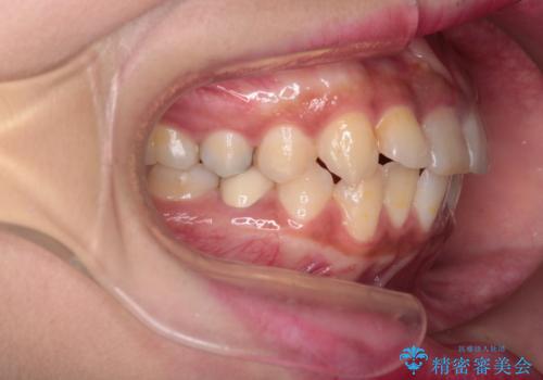 前歯の突出感を改善|上下4本の抜歯と審美ワイヤー矯正でバランスの取れた口元への治療前