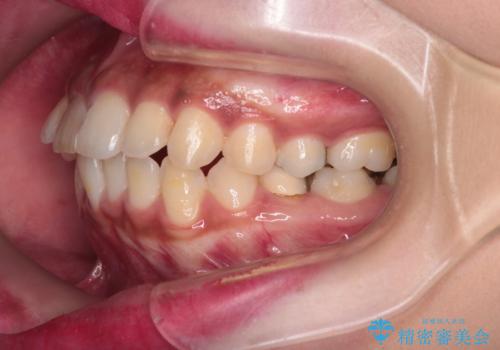 前歯の突出感を改善|上下4本の抜歯と審美ワイヤー矯正でバランスの取れた口元への治療前