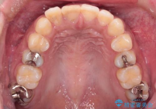 前歯の突出感を改善|上下4本の抜歯と審美ワイヤー矯正でバランスの取れた口元への治療前