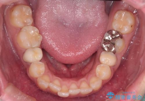 前歯の突出感を改善|上下4本の抜歯と審美ワイヤー矯正でバランスの取れた口元への治療前