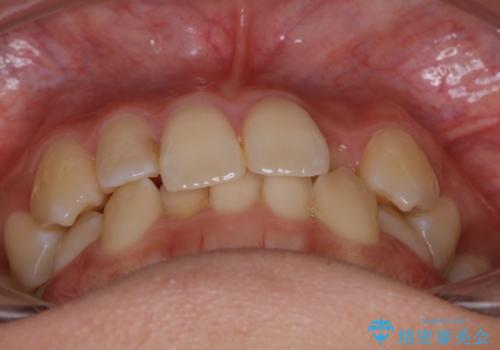 下顎前歯の先天欠損と上顎前歯のクロスバイト:インビザライン治療の治療前