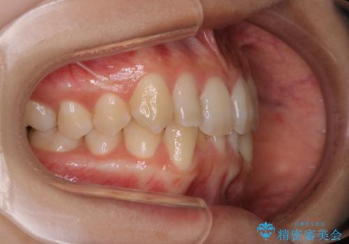 下顎前歯の先天欠損と上顎前歯のクロスバイト:インビザライン治療の治療前