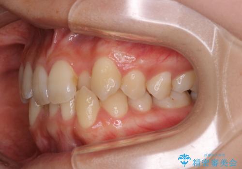 下顎前歯の先天欠損と上顎前歯のクロスバイト:インビザライン治療の治療前