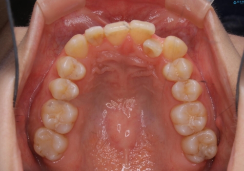 下顎前歯の先天欠損と上顎前歯のクロスバイト:インビザライン治療の治療前