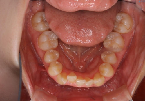 下顎前歯の先天欠損と上顎前歯のクロスバイト:インビザライン治療の治療前