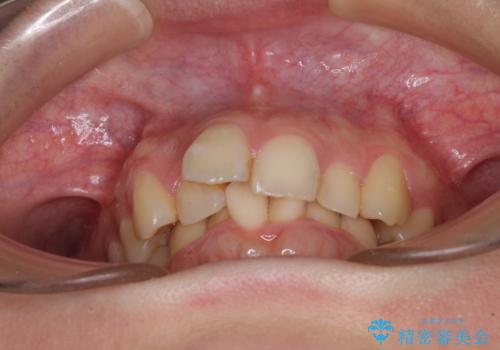 【モニター】デコボコ前歯を治したい ワイヤー装置での抜歯矯正治療の治療前