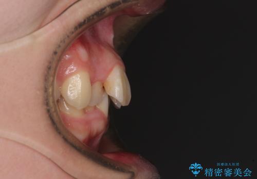 【モニター】デコボコ前歯を治したい ワイヤー装置での抜歯矯正治療の治療前