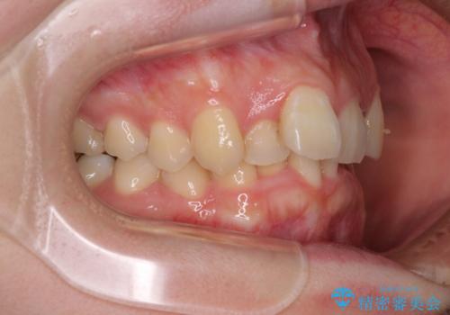 【モニター】デコボコ前歯を治したい ワイヤー装置での抜歯矯正治療の治療前