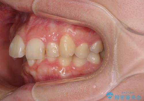 【モニター】デコボコ前歯を治したい ワイヤー装置での抜歯矯正治療の治療前