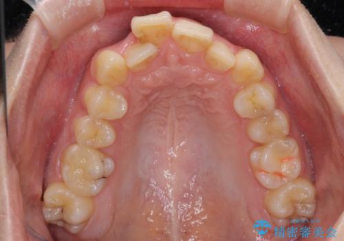 【モニター】デコボコ前歯を治したい ワイヤー装置での抜歯矯正治療の治療前