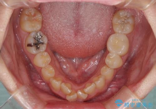 【モニター】デコボコ前歯を治したい ワイヤー装置での抜歯矯正治療の治療前