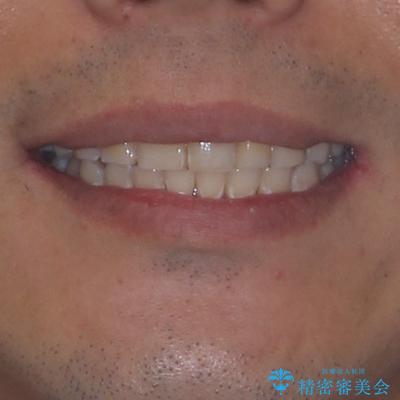 深い咬み合わせと前歯のデコボコ ワイヤー装置での抜歯矯正の治療後(顔貌)