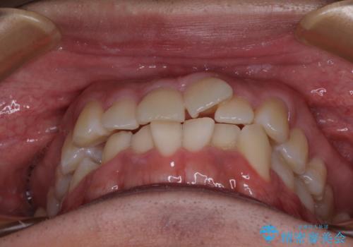 前方に捻れた前歯を治したい インビザライン矯正治療の治療前