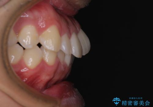 前方に捻れた前歯を治したい インビザライン矯正治療の治療前