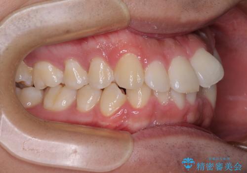 前方に捻れた前歯を治したい インビザライン矯正治療の治療前