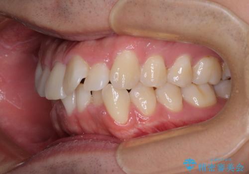 前方に捻れた前歯を治したい インビザライン矯正治療の治療前