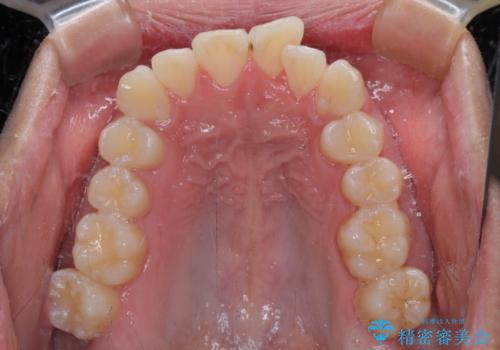 前方に捻れた前歯を治したい インビザライン矯正治療の治療前