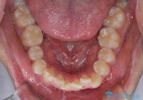 前方に捻れた前歯を治したい インビザライン矯正治療の治療前