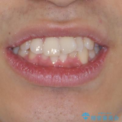 前方に捻れた前歯を治したい インビザライン矯正治療の治療前(顔貌)