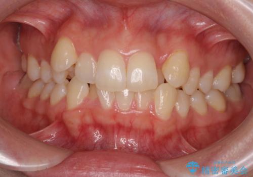 八重歯が気になる。補助装置を併用したワイヤー矯正の症例 治療前