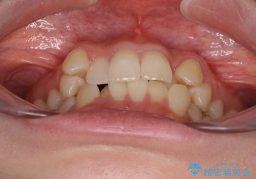 八重歯が気になる。補助装置を併用したワイヤー矯正の治療前