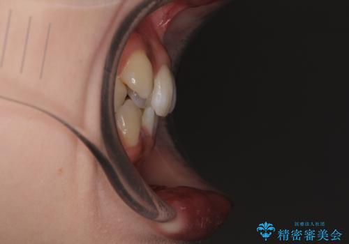 八重歯が気になる。補助装置を併用したワイヤー矯正の治療前