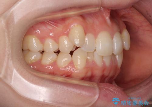 八重歯が気になる。補助装置を併用したワイヤー矯正の治療前