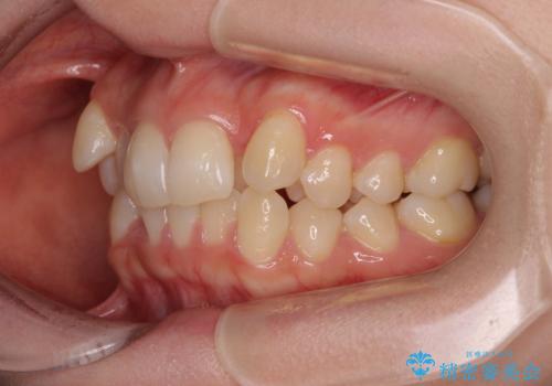 八重歯が気になる。補助装置を併用したワイヤー矯正の治療前