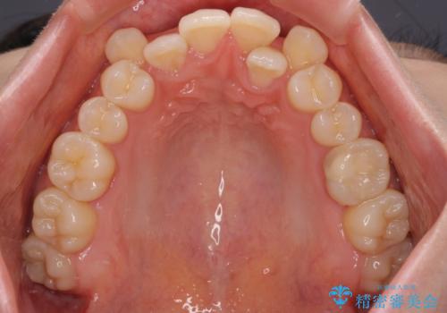 八重歯が気になる。補助装置を併用したワイヤー矯正の治療前