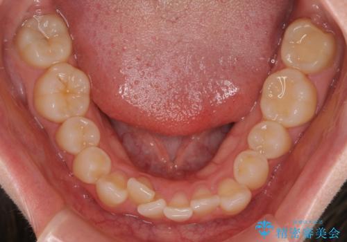 八重歯が気になる。補助装置を併用したワイヤー矯正の治療前