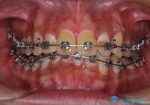 【モニター】飛び出した上の前歯 非抜歯矯正で整った口元にの治療中