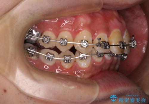 【モニター】飛び出した上の前歯 非抜歯矯正で整った口元にの治療中
