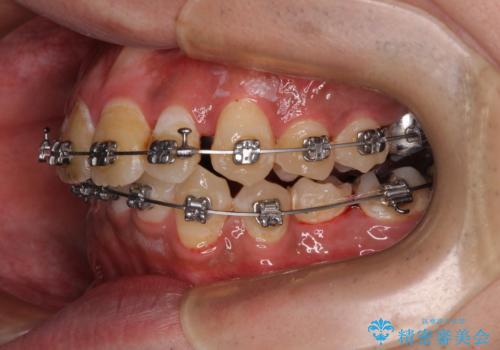 【モニター】飛び出した上の前歯 非抜歯矯正で整った口元にの治療中