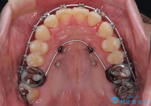 【モニター】飛び出した上の前歯 非抜歯矯正で整った口元にの治療中