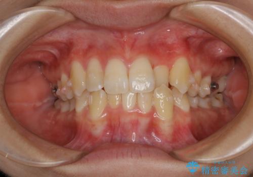 下顎前歯の先天欠損と上顎前歯のクロスバイト:インビザライン治療の治療中