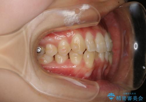 下顎前歯の先天欠損と上顎前歯のクロスバイト:インビザライン治療の治療中