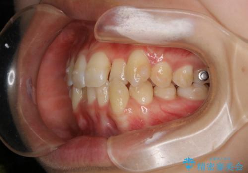 下顎前歯の先天欠損と上顎前歯のクロスバイト:インビザライン治療の治療中