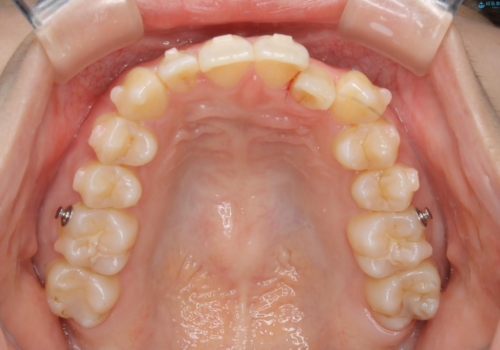 下顎前歯の先天欠損と上顎前歯のクロスバイト:インビザライン治療の治療中