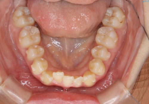 下顎前歯の先天欠損と上顎前歯のクロスバイト:インビザライン治療の治療中