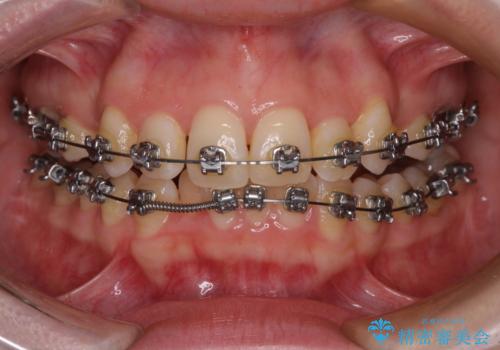 八重歯が気になる。補助装置を併用したワイヤー矯正の治療中