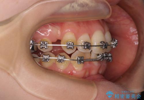 八重歯が気になる。補助装置を併用したワイヤー矯正の治療中