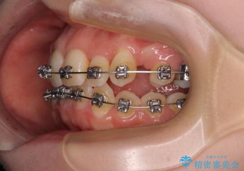 八重歯が気になる。補助装置を併用したワイヤー矯正の治療中