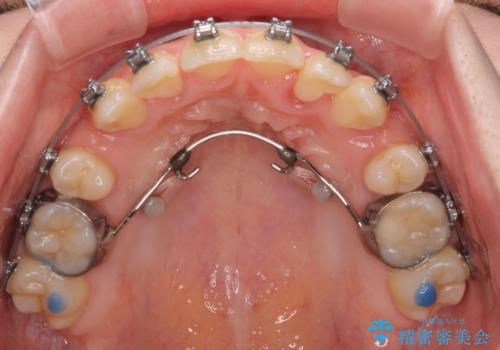 八重歯が気になる。補助装置を併用したワイヤー矯正の治療中